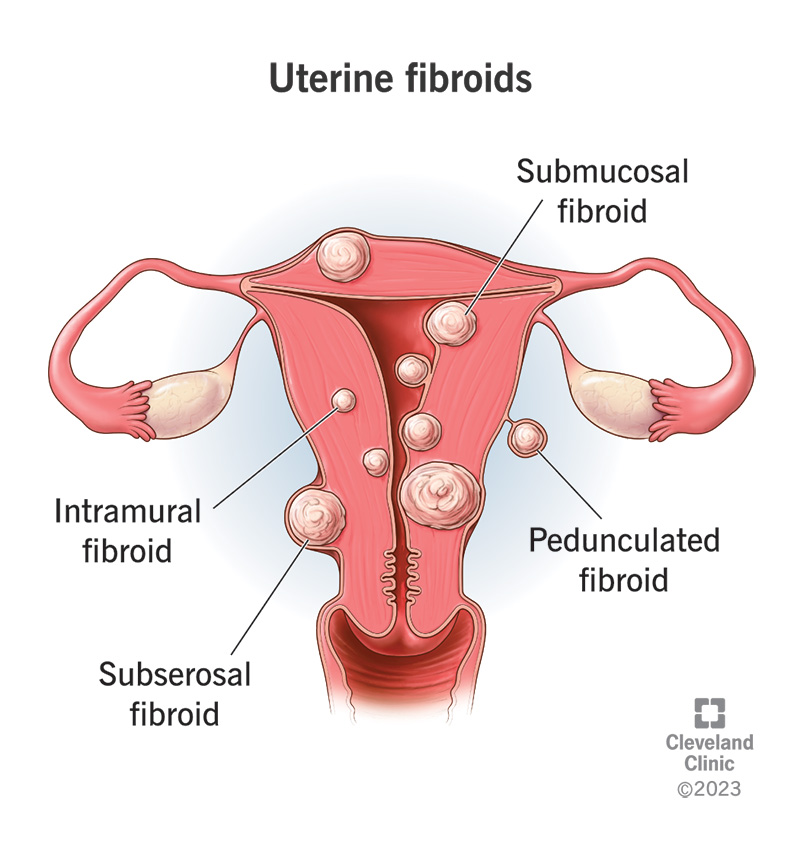 uterine-fibroids