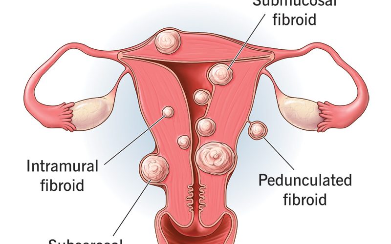 The type of Fibroid and their locations
